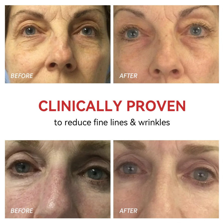 Cetosy™ Eyelume Therapy - Red Light Therapy for Eyes | Reduce Fine Lines and Wrinkles | Anti Eye Bags