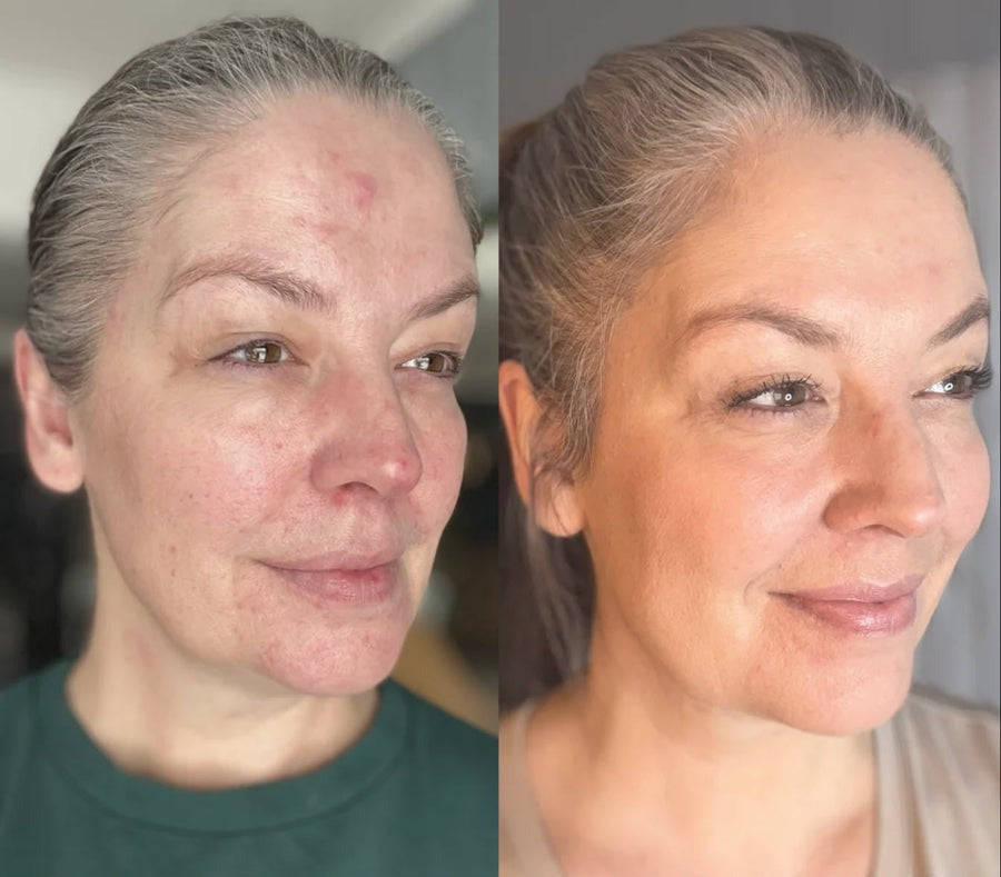 Cetosy™ 7 color LED Therapy Mask: smoother skin effortlessly